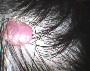 angioma